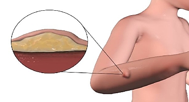 Yağ Bezesi Hakkında Doğru Bilinen 5 Yanlış!