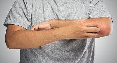 Soğuk Hava Ve Rüzgar egzamayı Tetikliyor! 